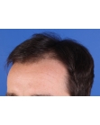 Before Hair Transplant&nbsp;Hairlines